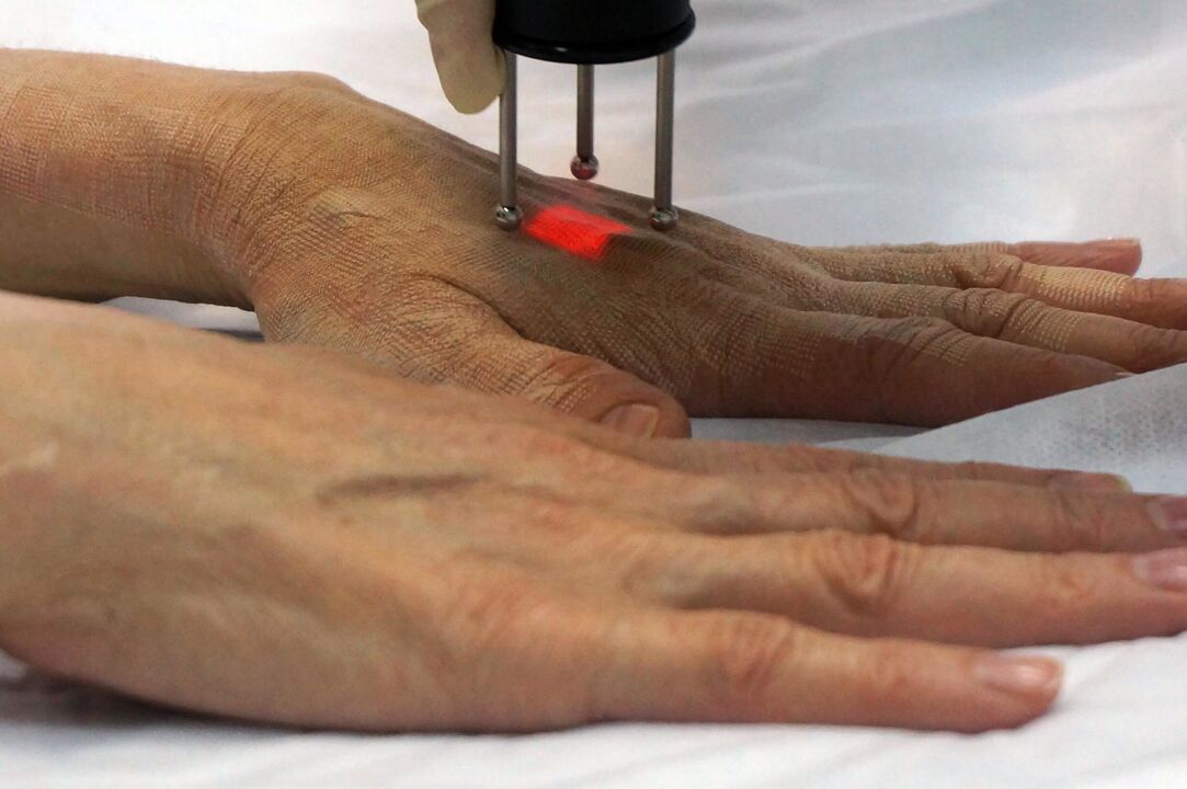 Laser rejuvenation of the hands by a non-ablative method