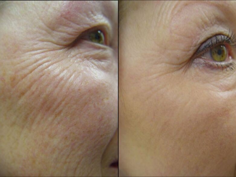 Before and after the laser rejuvenation procedure - a significant reduction in wrinkles