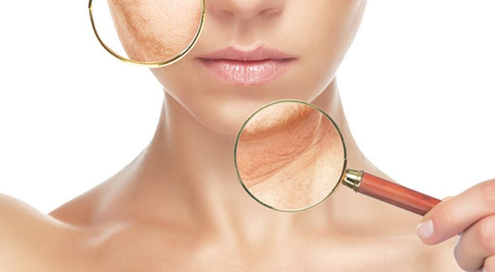 Wrinkles can be effectively removed with laser therapy. 
