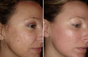 laser rejuvenation for facial skin before and after photos